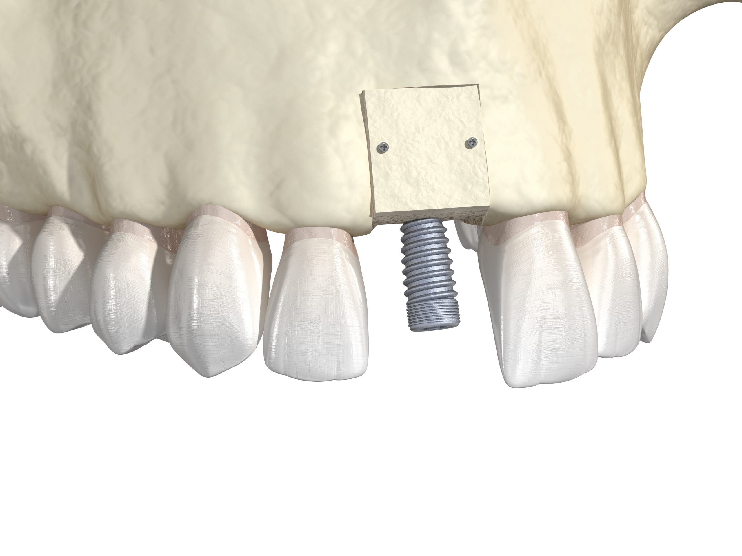 Bone Grafting for Implants What to Expect