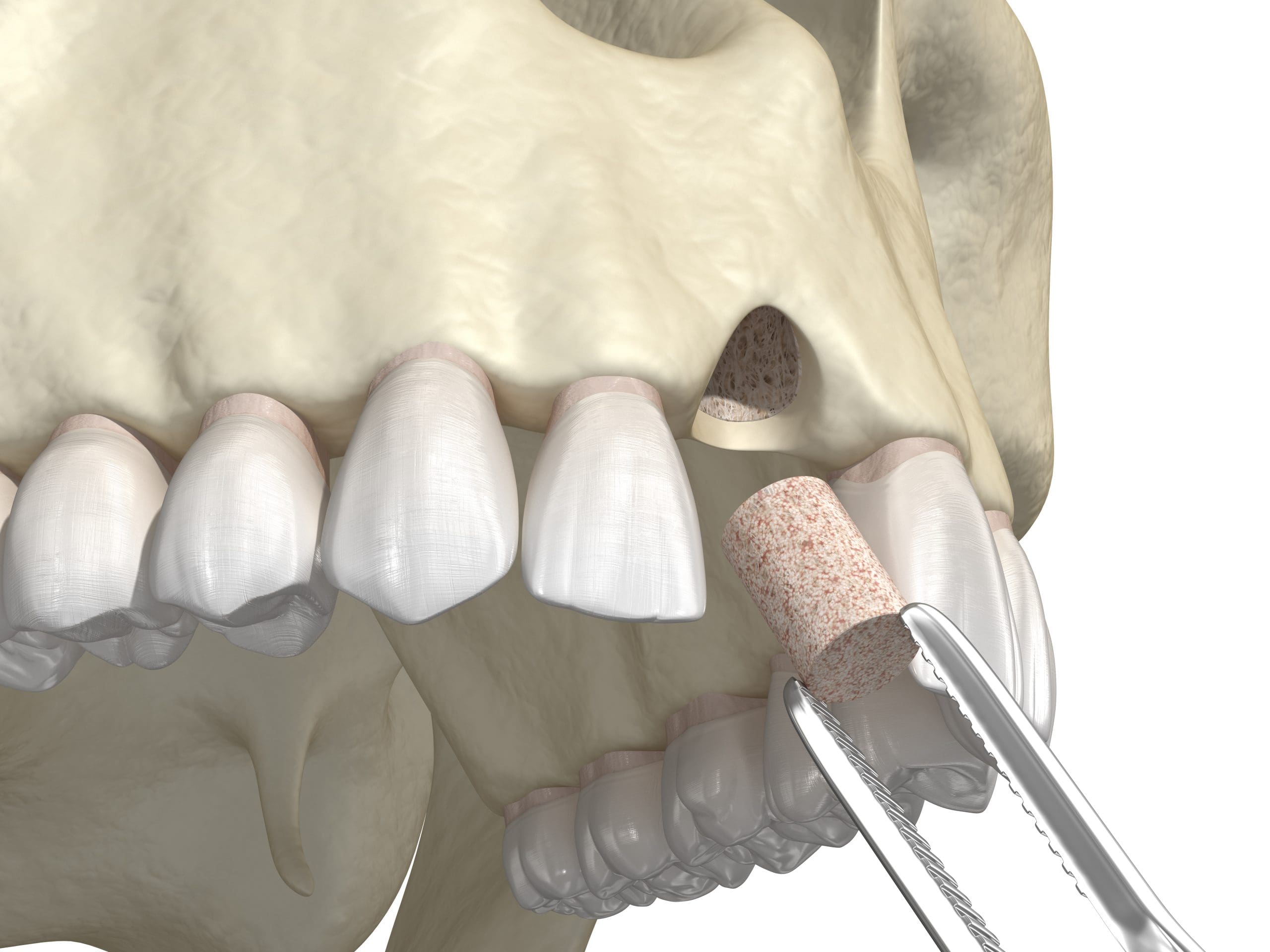 Types of Bone Grafts Explained Simply